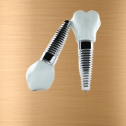 Dental Implants Image